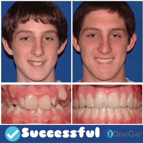 braces before and after images 