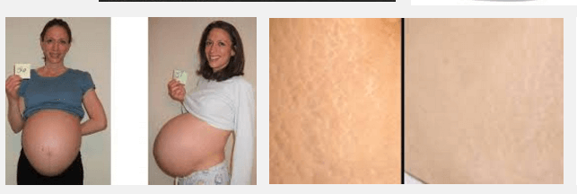 Coconut oil for stretch marks during pregnancy