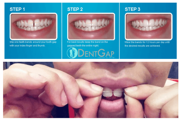 tooth-gap-bands-results