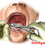emergency tooth extraction
