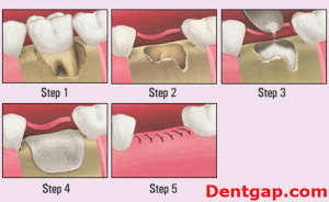 tooth extractio | Dentgap