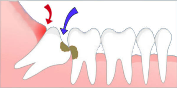 wisdom tooth in wrong angle