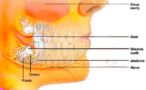 Symptoms of wisdom teeth