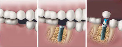 Tooth implants