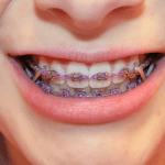 braces rubber bands
