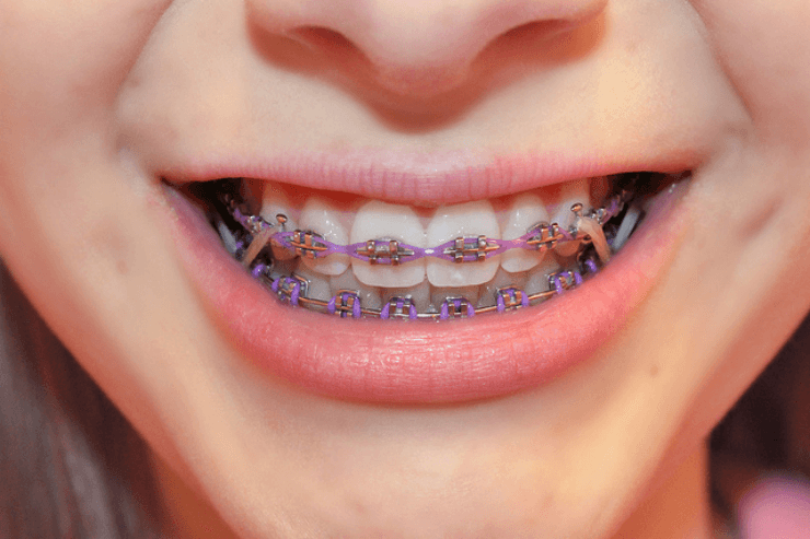 Are braces necessary? - Kidtastic Dental