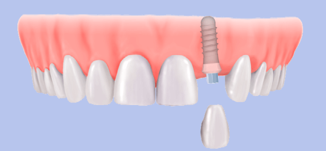 dental implants at least price