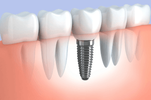 low-cost dental implants