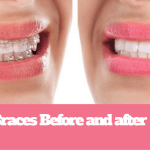 Braces Before and after