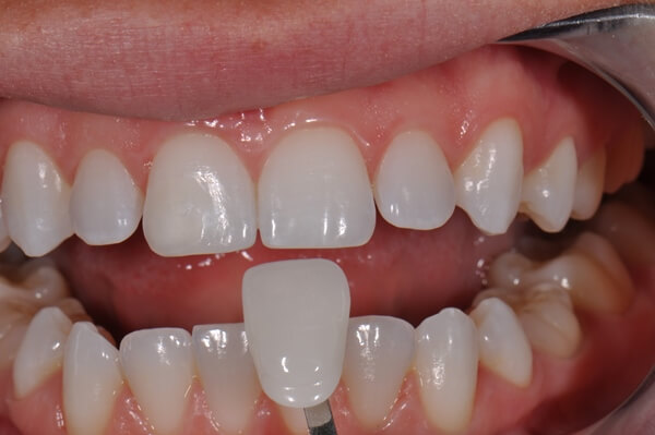 Veneers before and after images