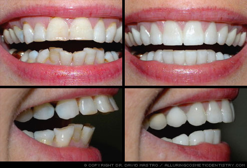 Veneers Before and After - Pictures, Popularity, Time, Color, Pros
