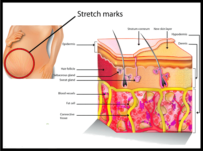 best way to get rid of stretch marks