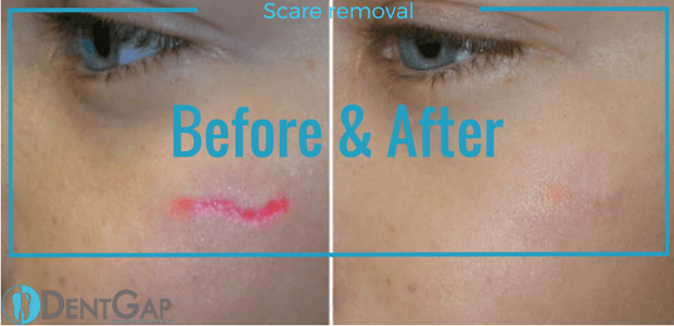 laser scar removal before and after