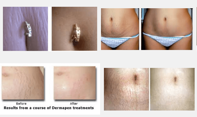 laser stretch mark removal before and after images