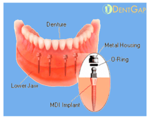 mini dental implants reviews