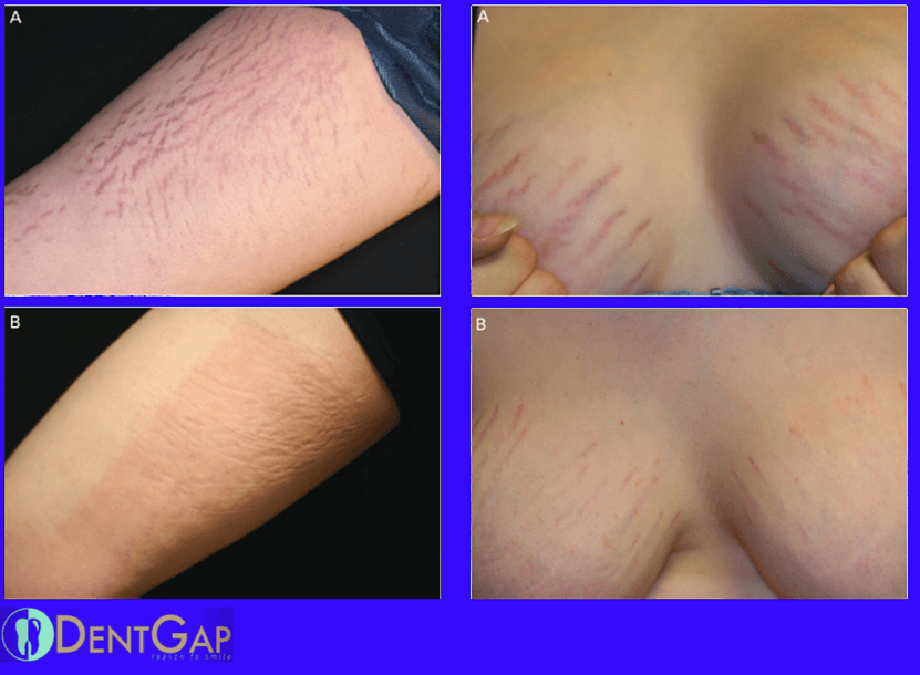 stretch mark laser removal before and after pictures