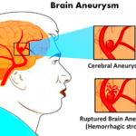 symptoms of brain aneurysm