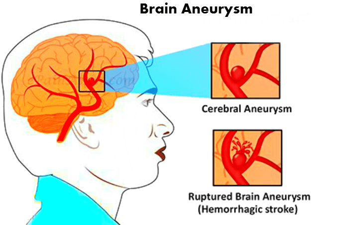 Symptoms of Brain Aneurysm: How to find Aneurysm in early days
