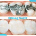 How Much Does a Filling Cost