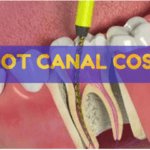 How Much is a Root Canal Cost