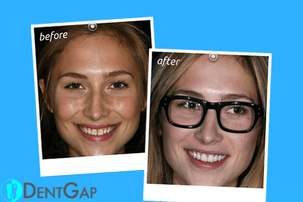 before-and-after-teeth-gap-bands