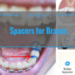 Spacers for Braces or expander for braces