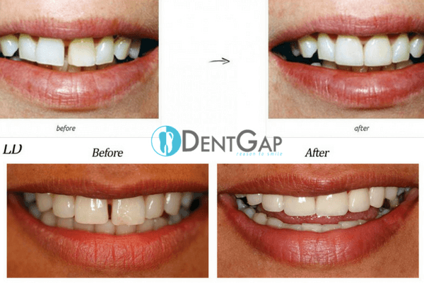 teeth-bands-before-and-after