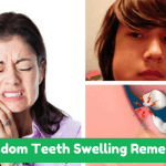 Wisdom Teeth Swelling