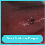 Black Spots on Tongue