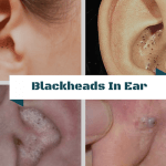 Blackheads In Ear