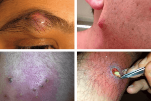 infected ingrown hair pictures and images
