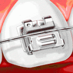 how self ligating braces works