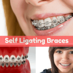 self Ligating braces, Pros, Cons, Cost, Brands