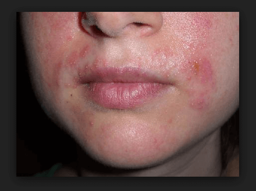 Candidiasis of Skin and Nails Symptoms & Easy Treatment