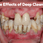 Side Effects of Deep Cleaning
