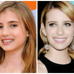 10 Celebrities with Veneers Before and After